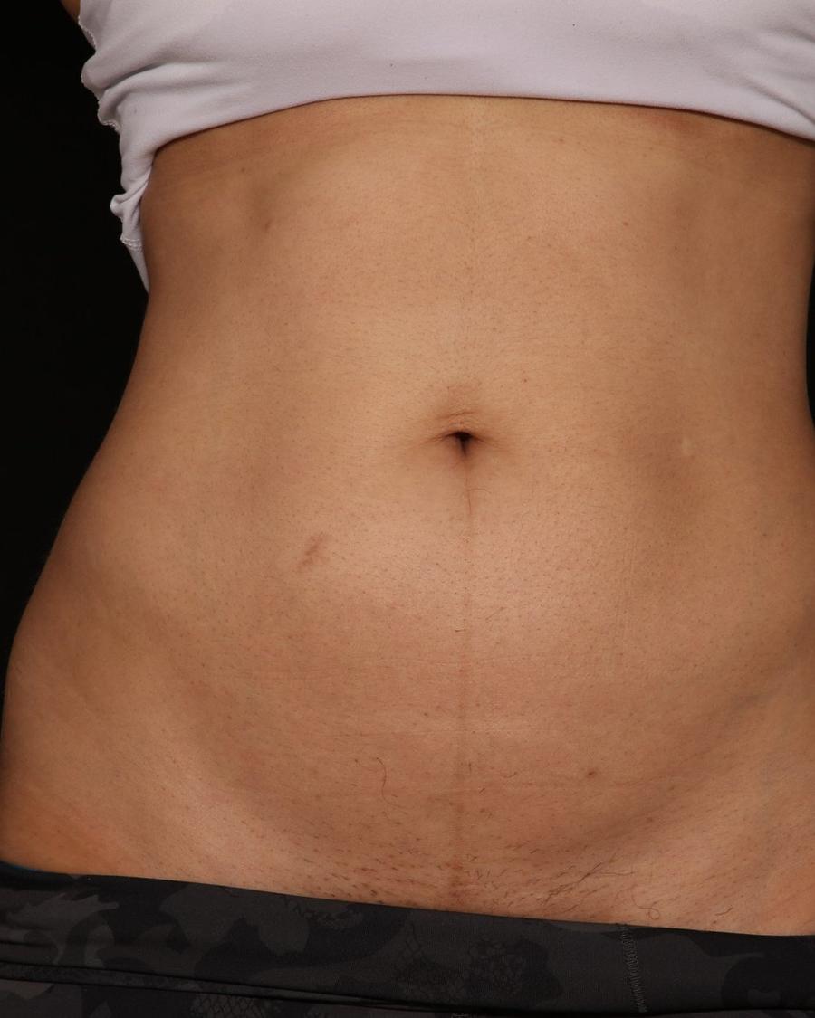 Emsculpt Neo after