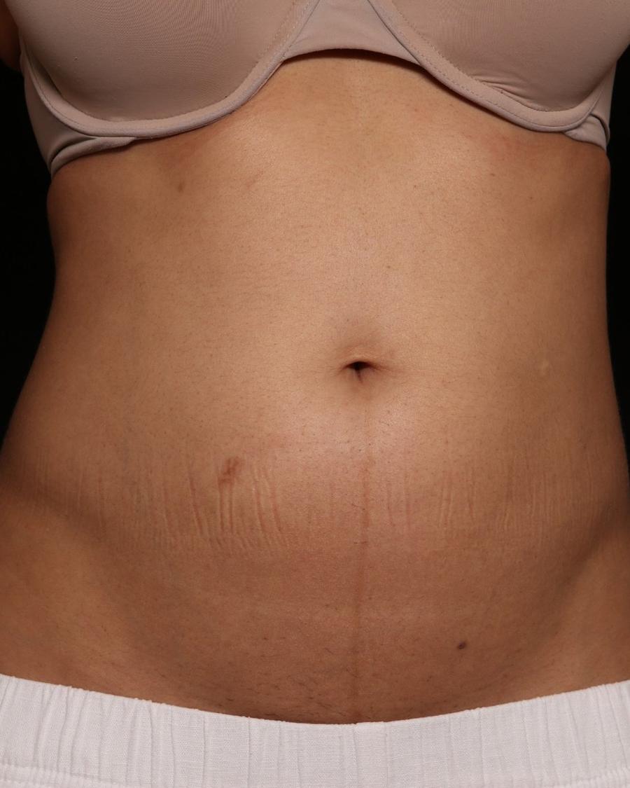 Emsculpt Neo before