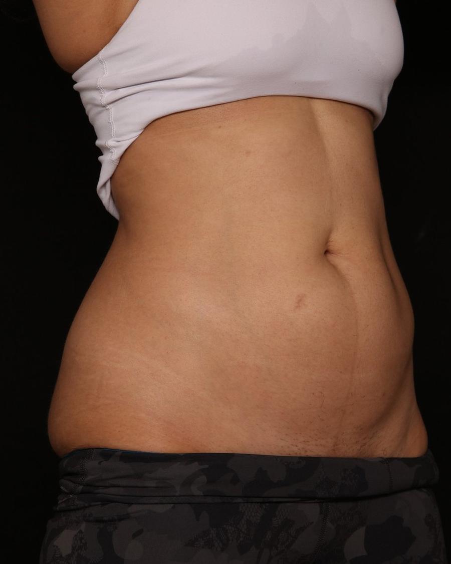 Emsculpt Neo after
