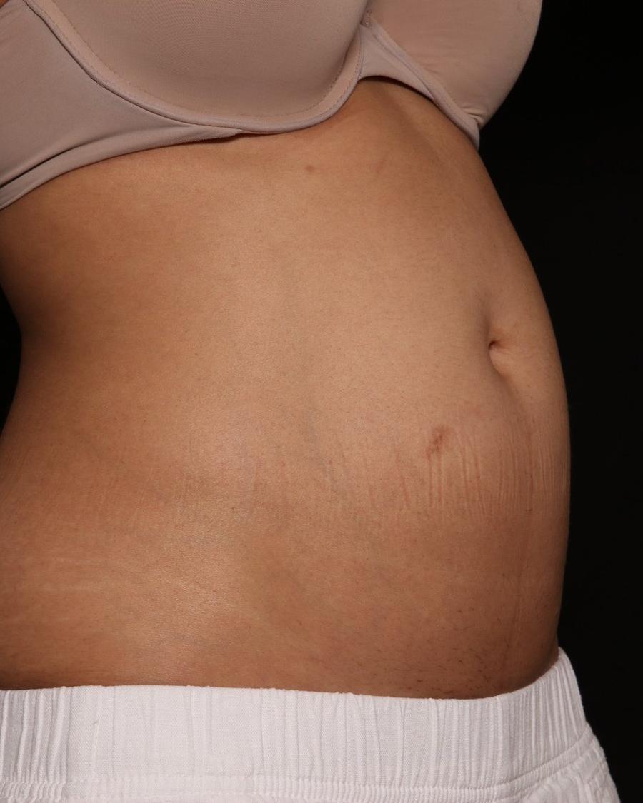 Emsculpt Neo before