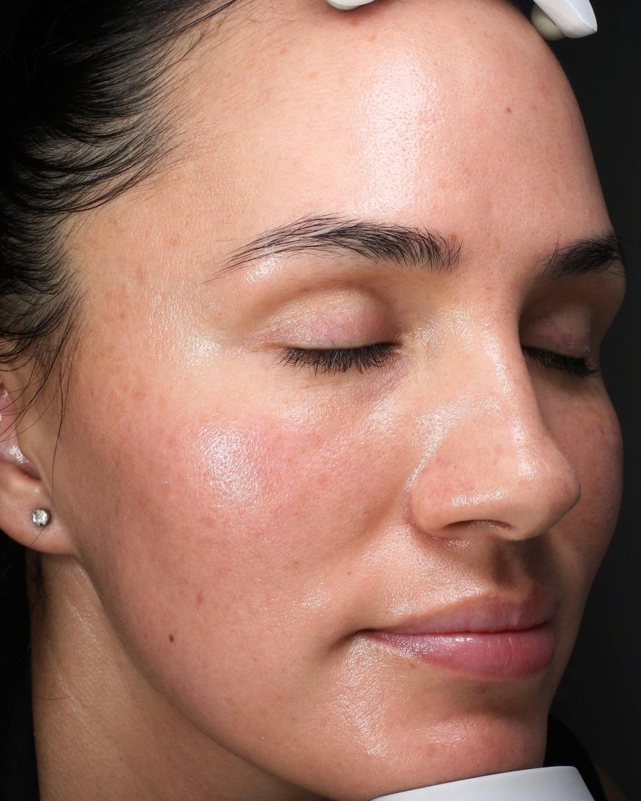 CryoTouch MD after