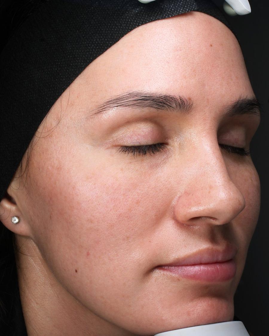CryoTouch MD before