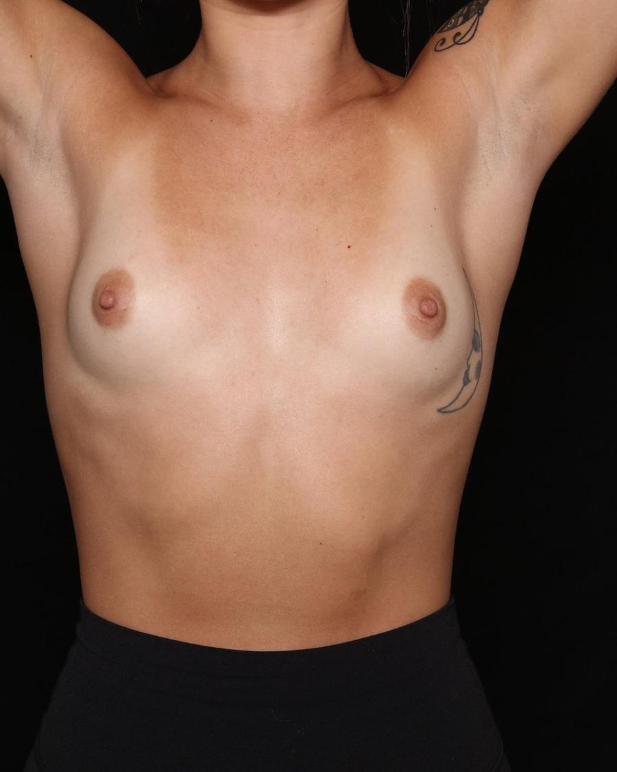 Breast Augmentation with Implants before