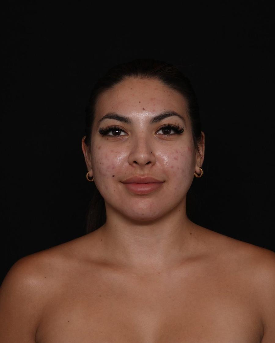 Neck Liposuction w/ Magic Tight after