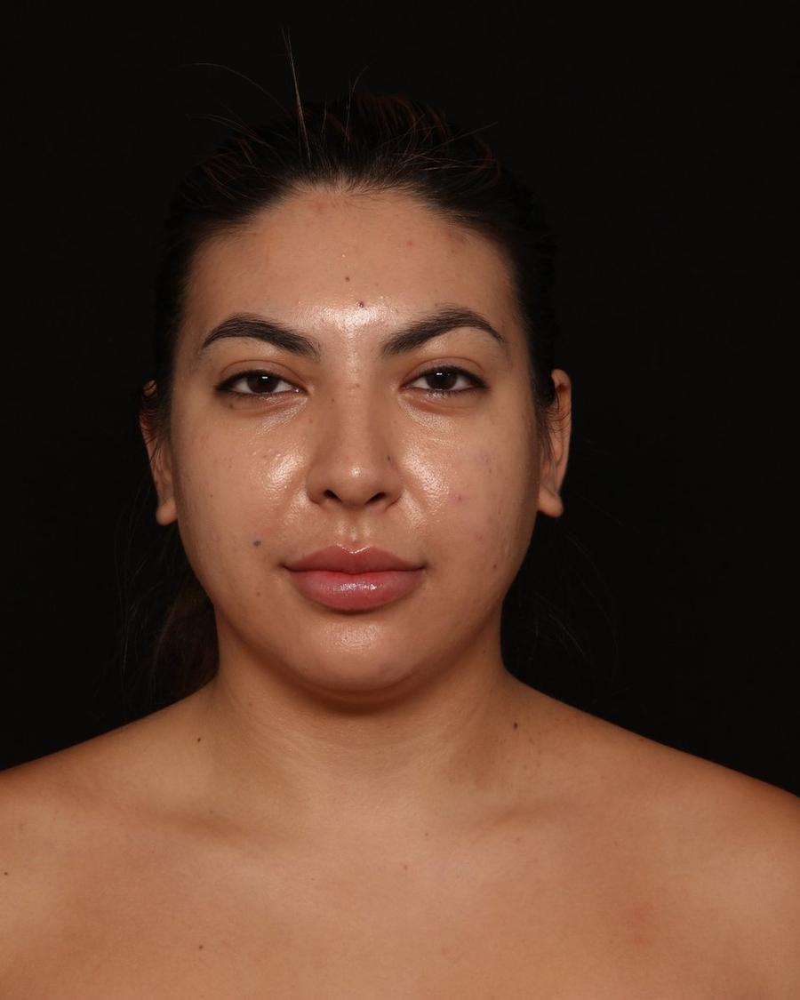 Neck Liposuction w/ Magic Tight before