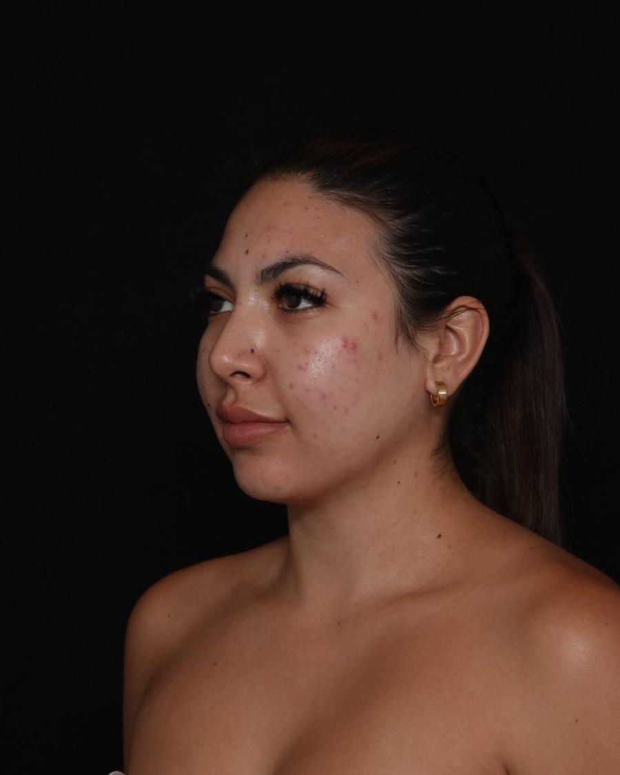 Neck Liposuction w/ Magic Tight after