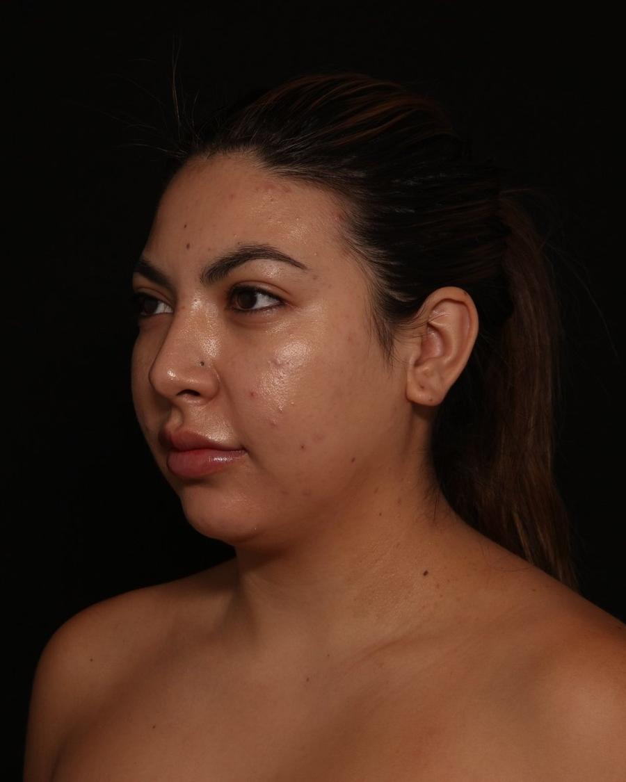 Neck Liposuction w/ Magic Tight before