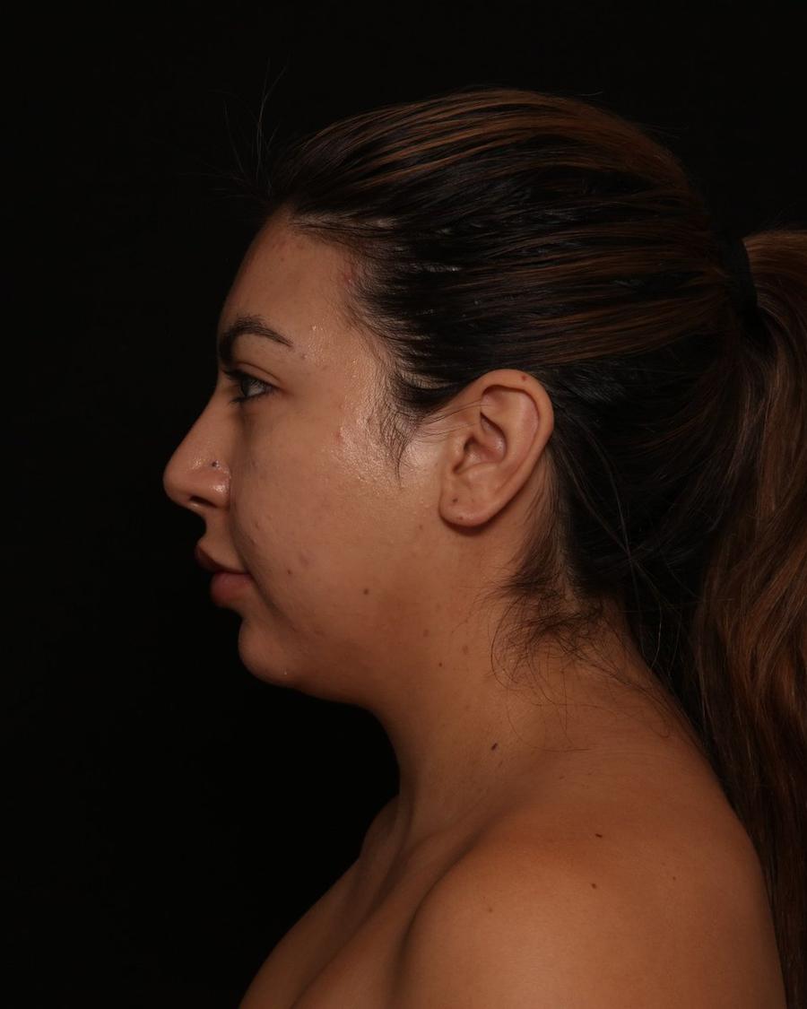 Neck Liposuction w/ Magic Tight before