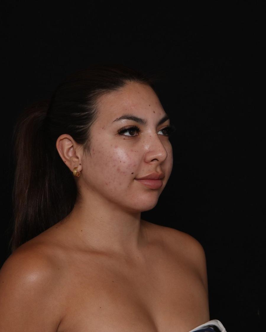 Neck Liposuction w/ Magic Tight after