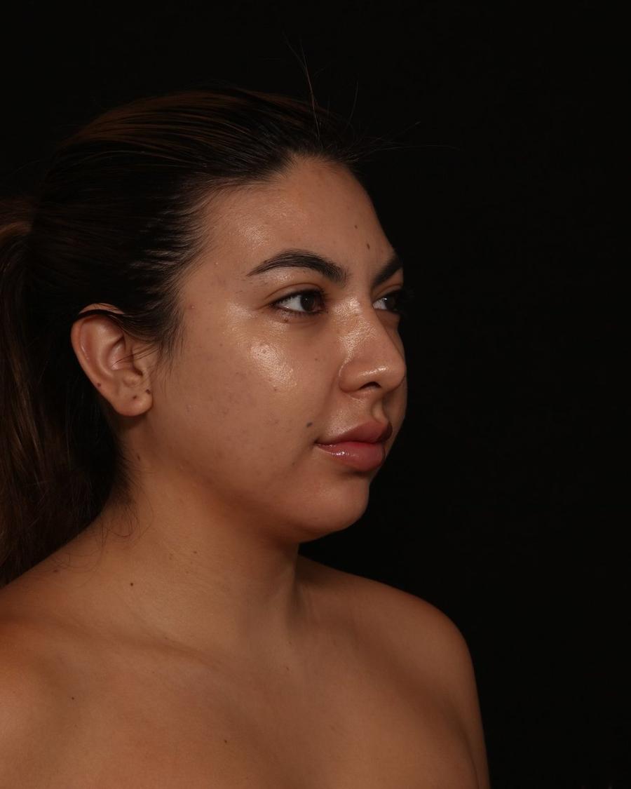 Neck Liposuction w/ Magic Tight before