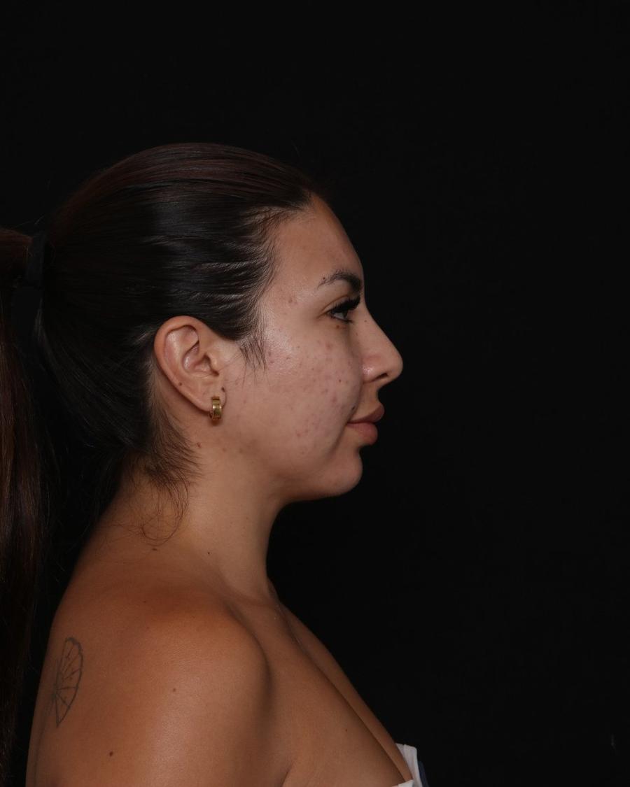 Neck Liposuction w/ Magic Tight after