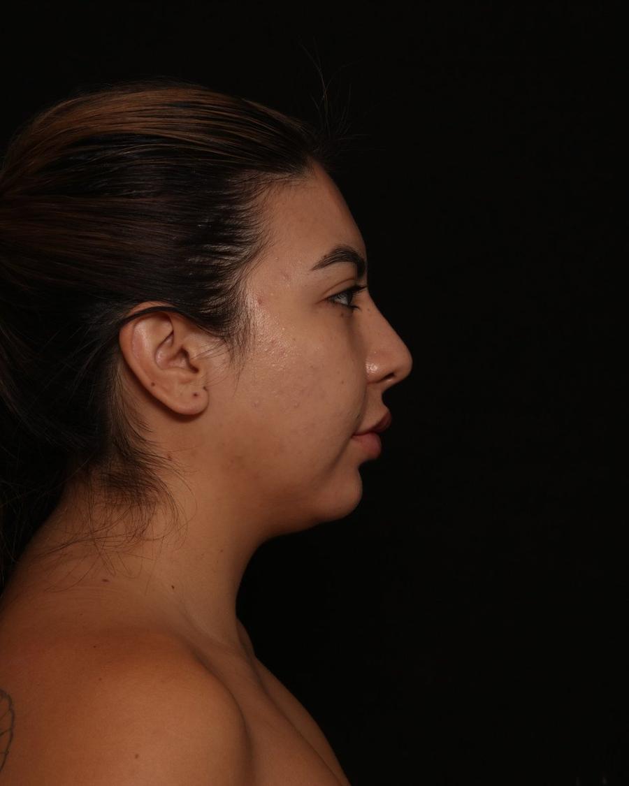 Neck Liposuction w/ Magic Tight before