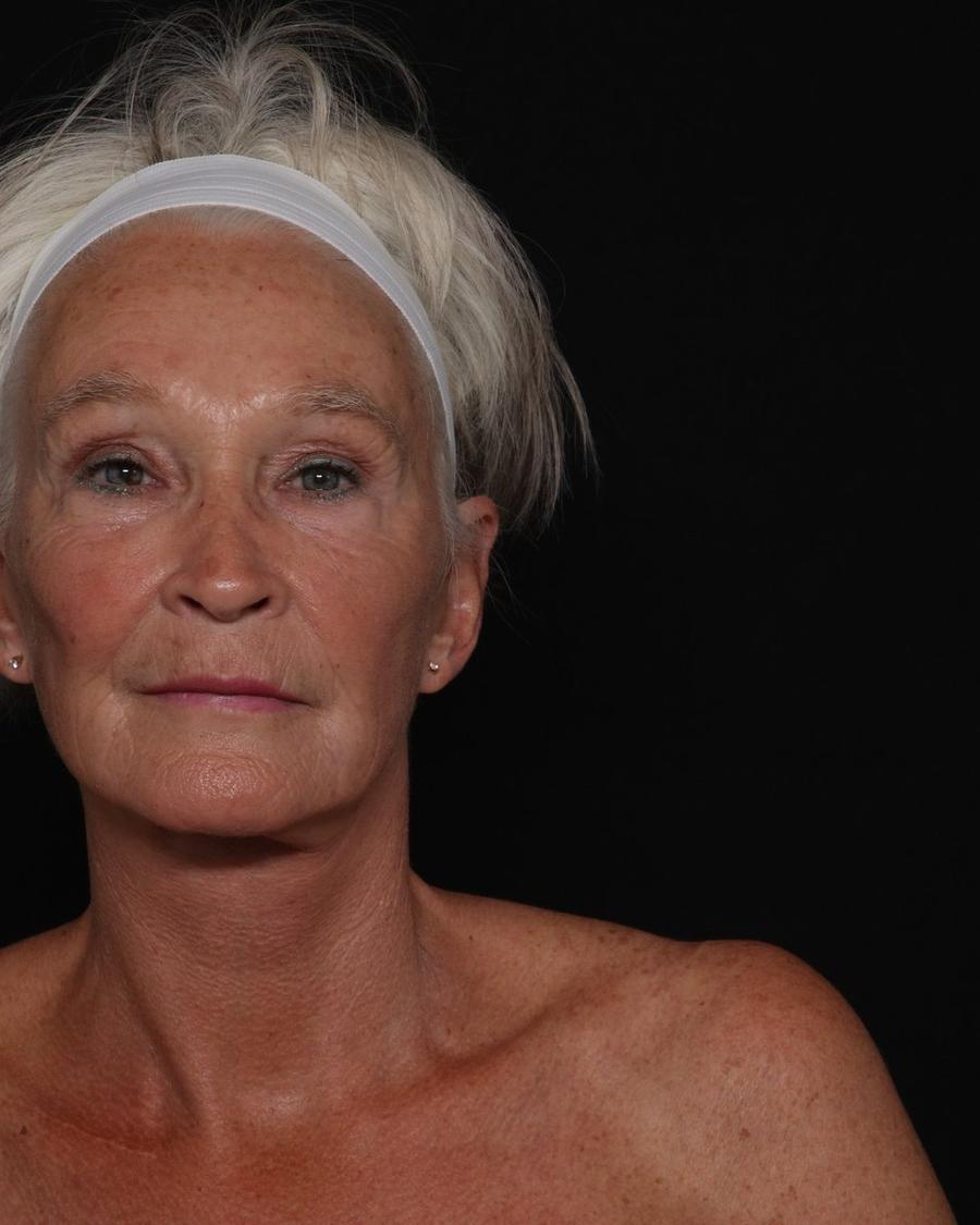 Facelift (neck lift included) after