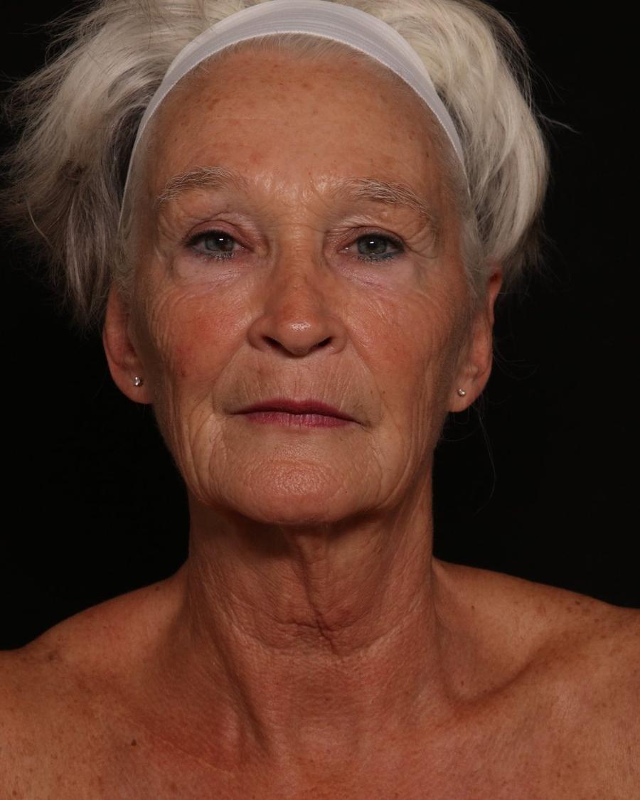 Facelift (neck lift included) before