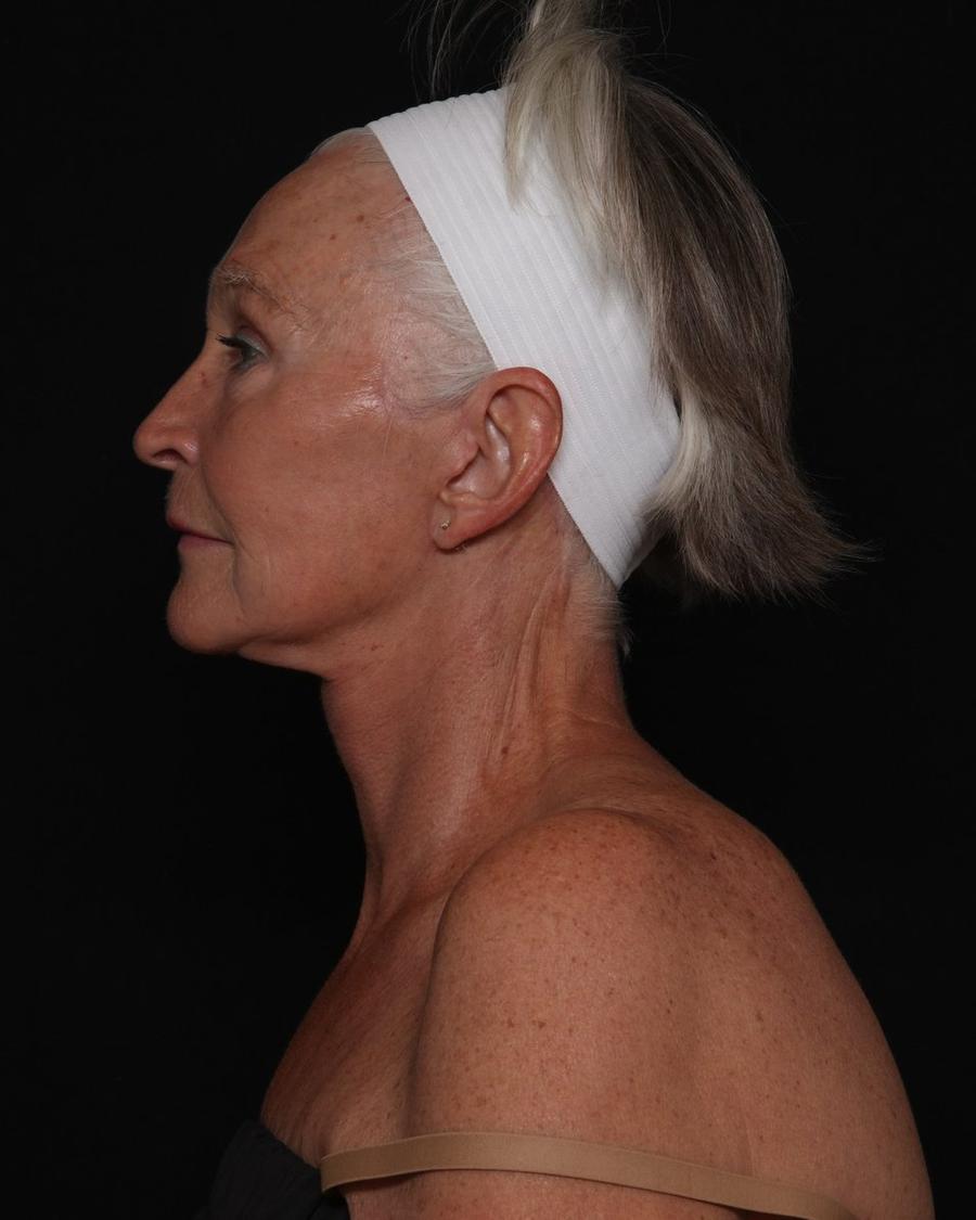 Facelift (neck lift included) after