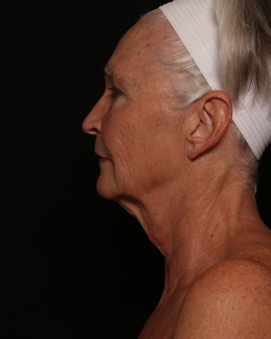 Facelift (neck lift included) before