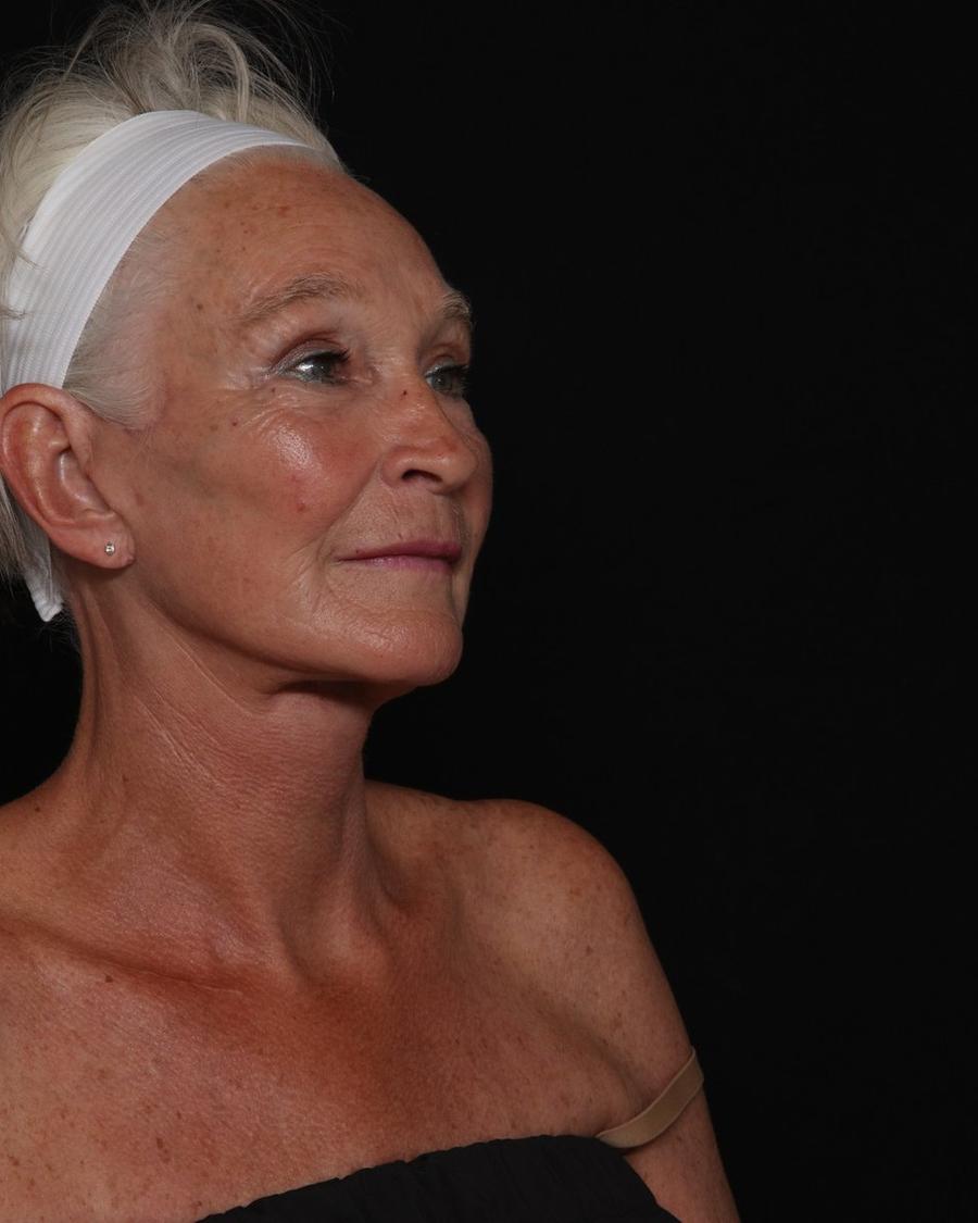 Facelift (neck lift included) after