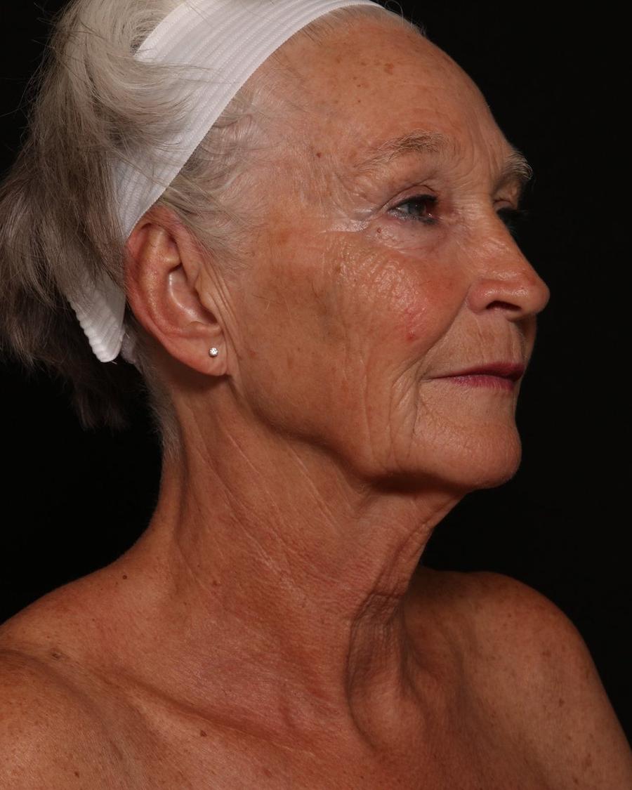 Facelift (neck lift included) before
