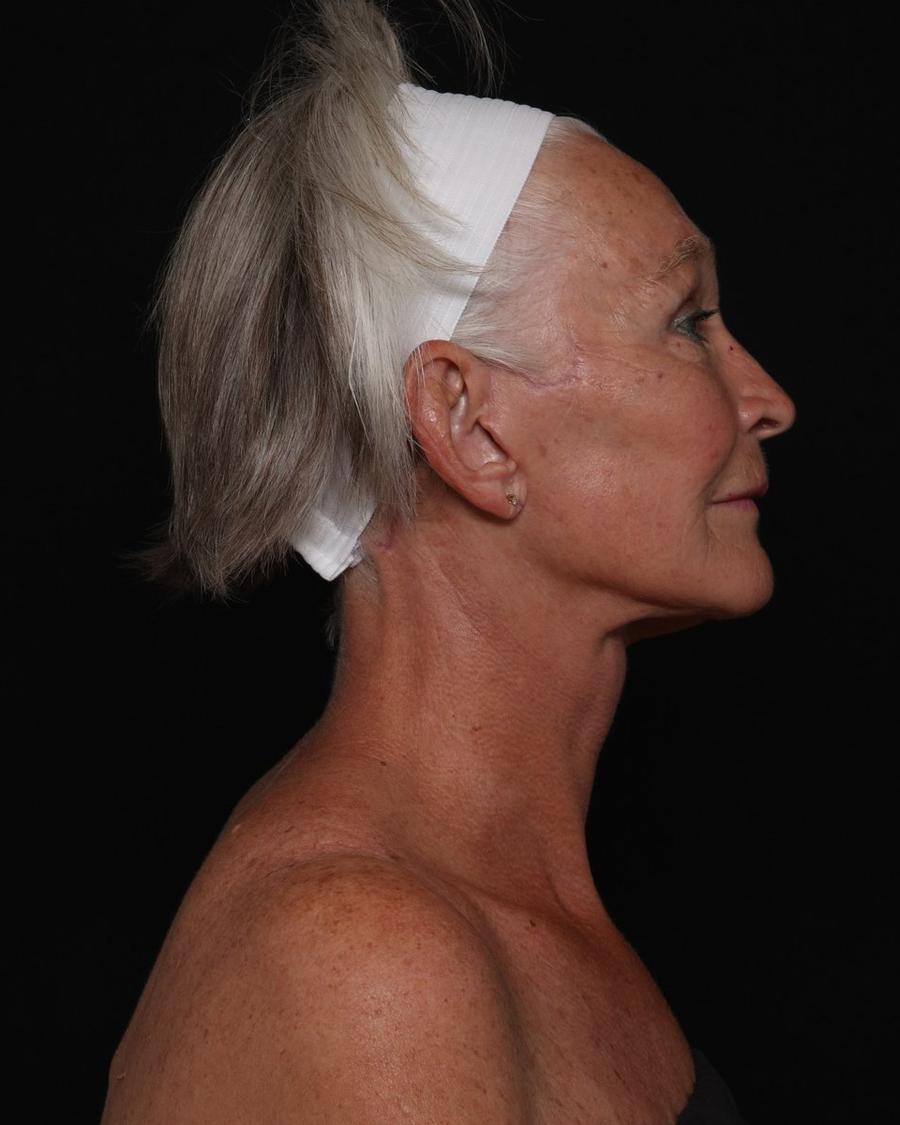 Facelift (neck lift included) after