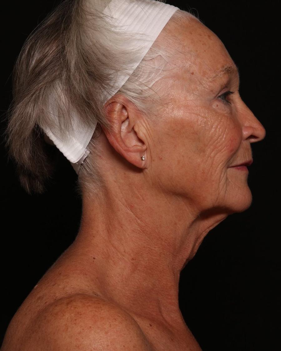 Facelift (neck lift included) before