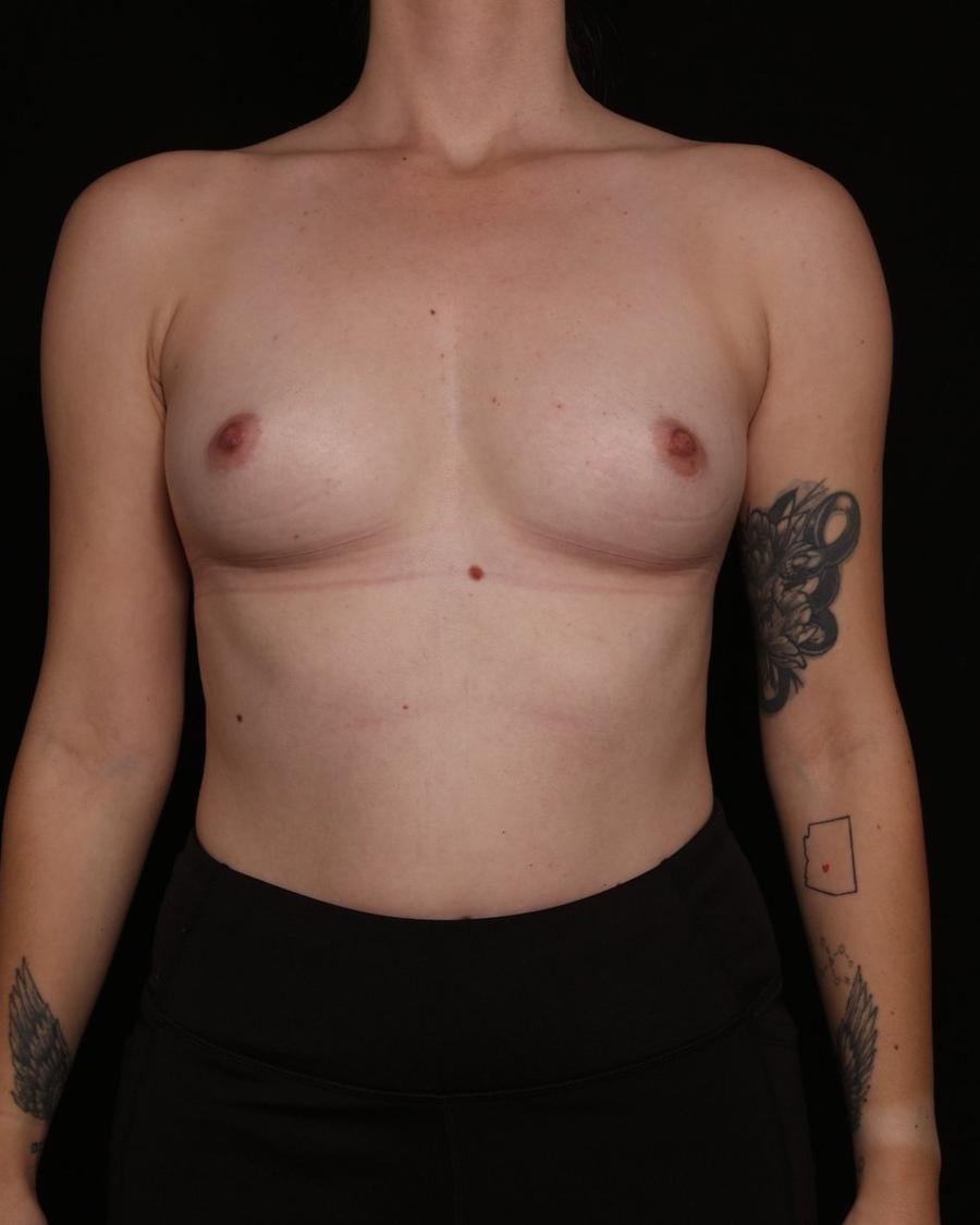 Breast Augmentation with Implants before