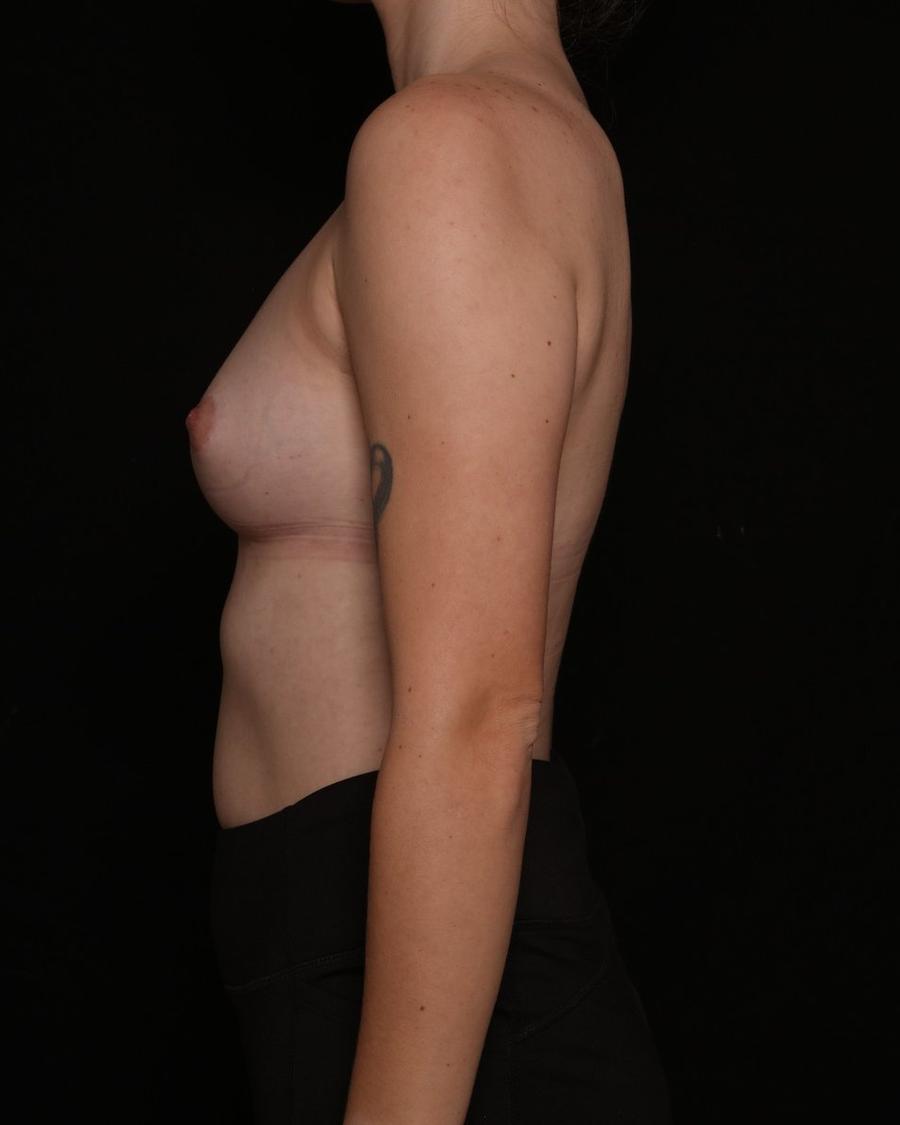 Breast Augmentation with Implants before