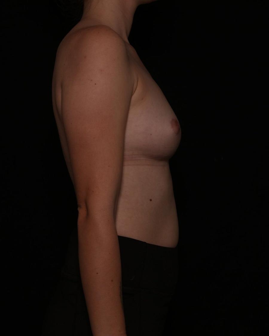 Breast Augmentation with Implants before