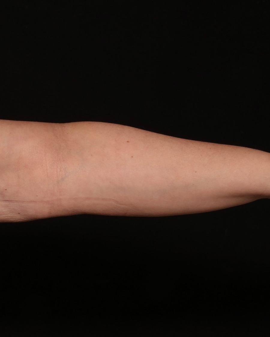 Arm Liposuction w/ Magic Tight after