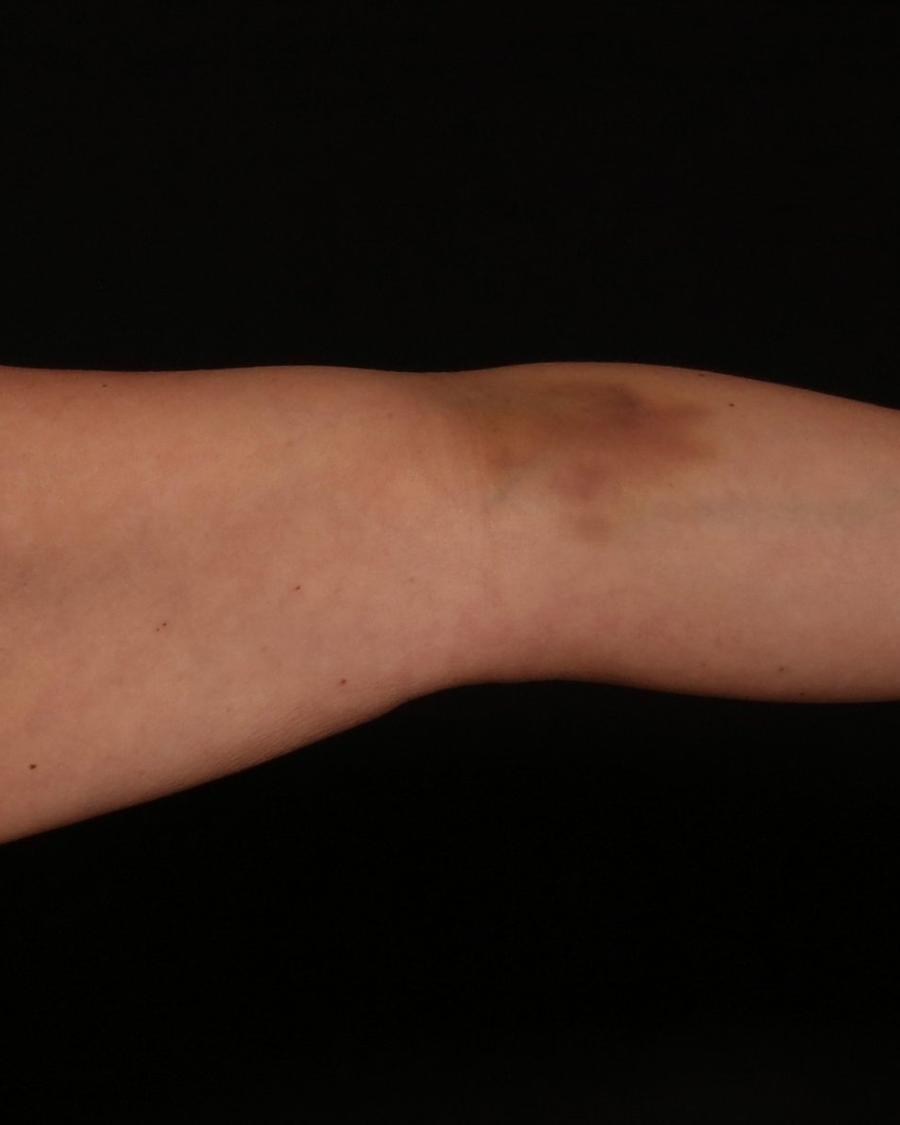 Arm Liposuction w/ Magic Tight before