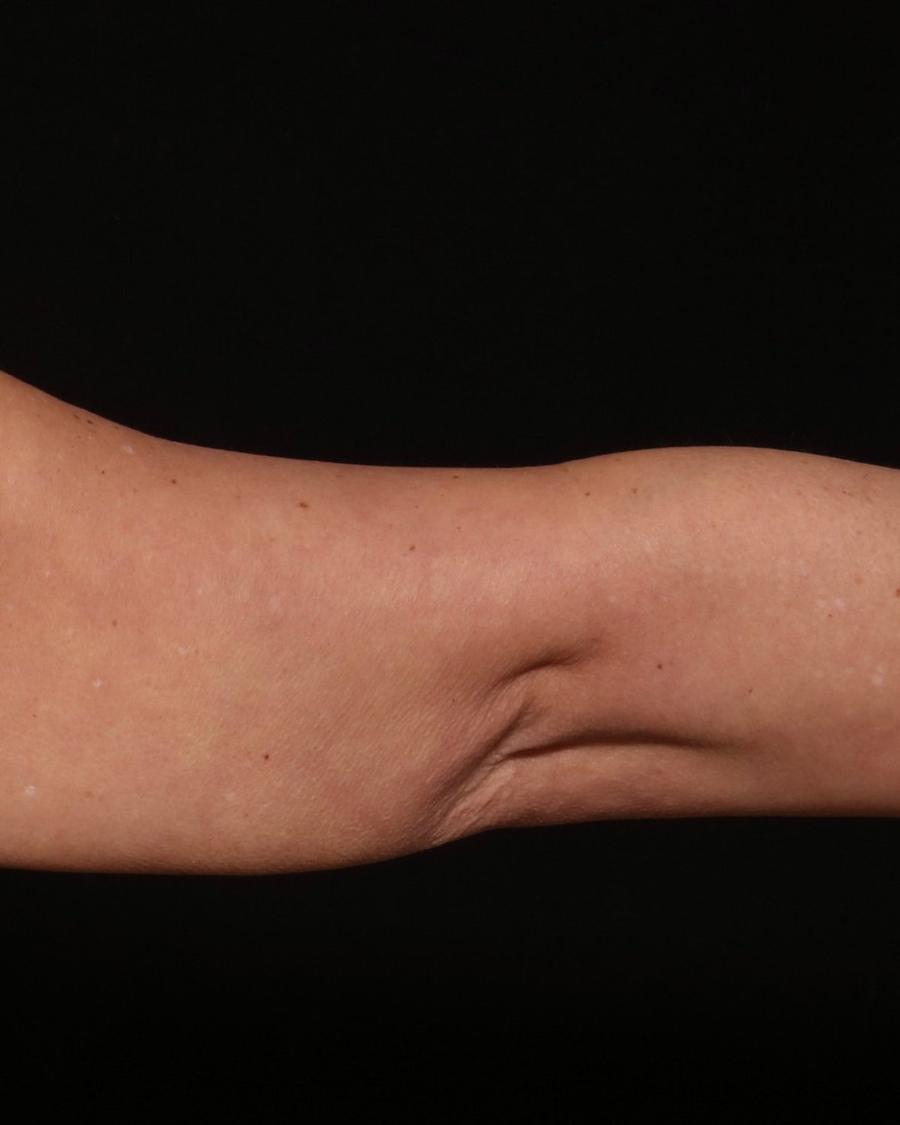 Arm Liposuction w/ Magic Tight after