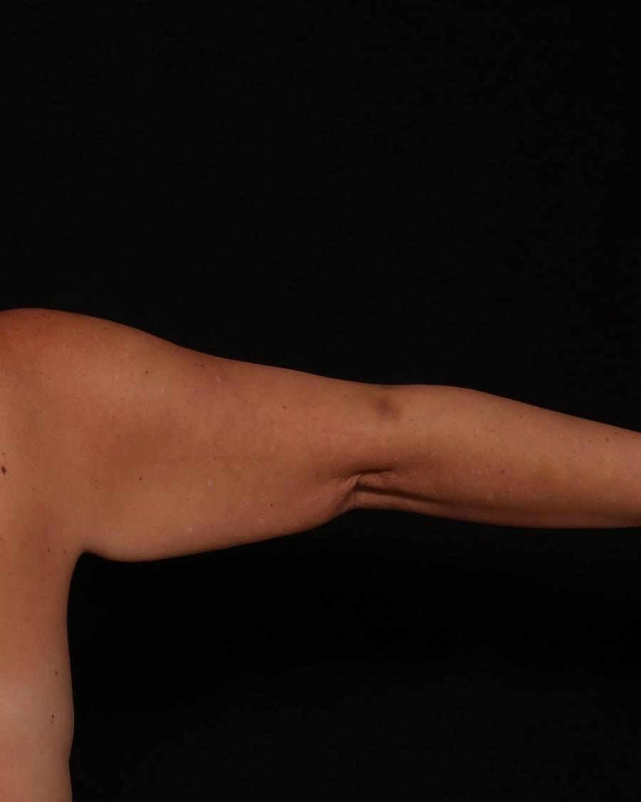 Arm Liposuction w/ Magic Tight before