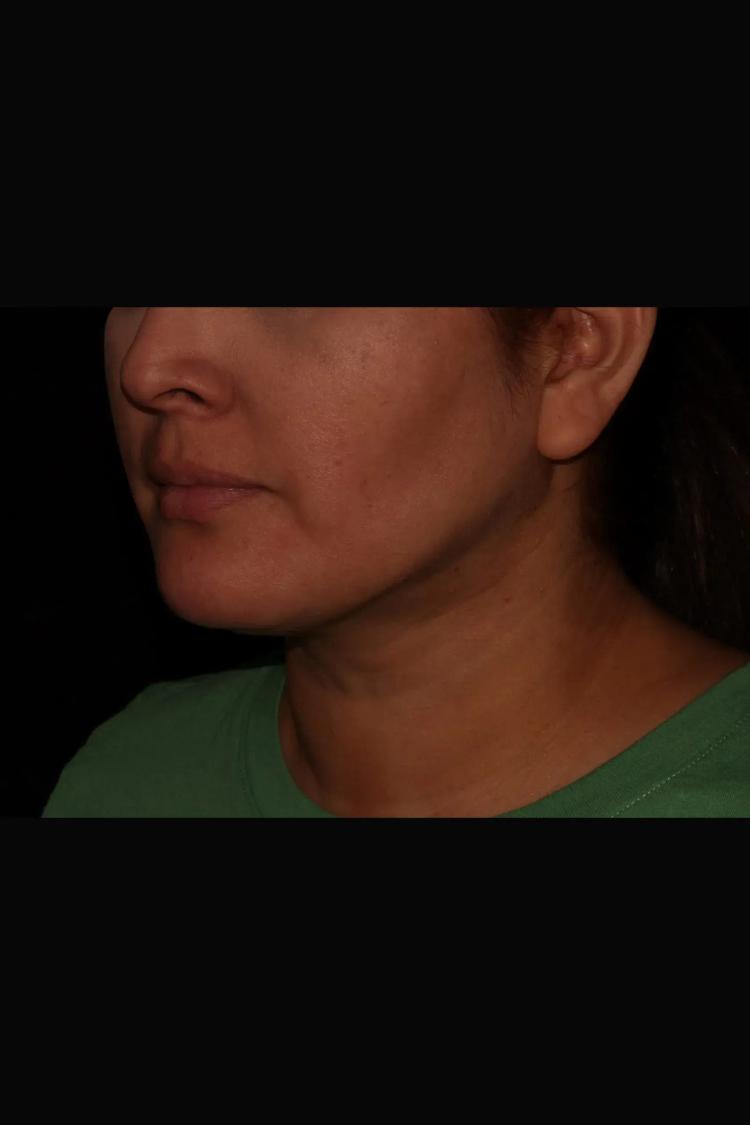 Buccal Fat Pad Removal, view 2, after