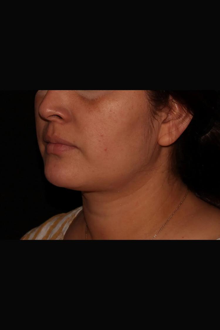 Buccal Fat Pad Removal, view 2, before