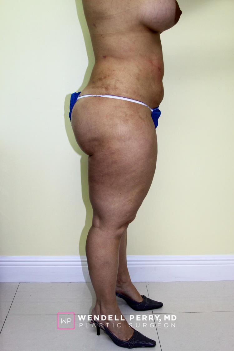 Liposuction, view 2, after