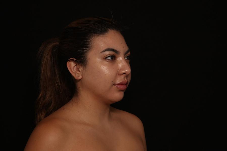 Neck Liposuction w/ Magic Tight, view 2, before