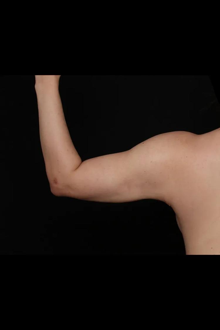 Arm Lift after