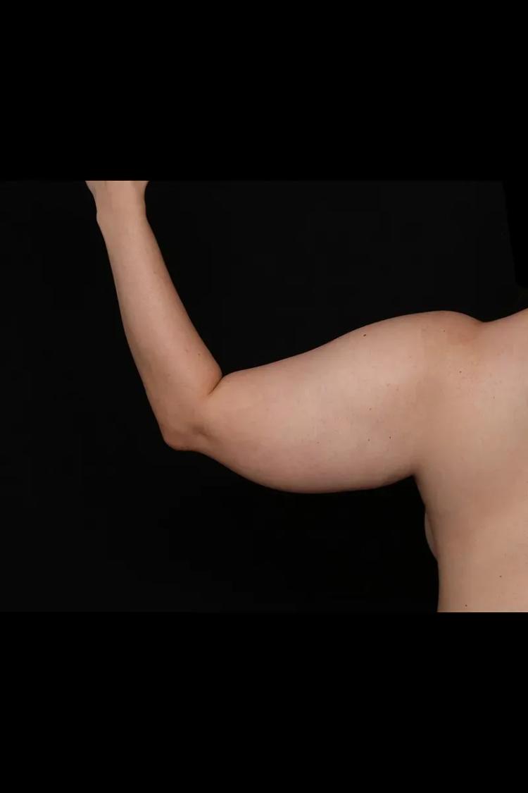 Arm Lift before