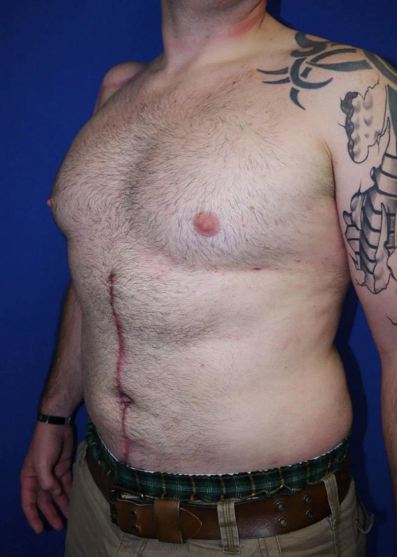 Tummy Tuck after