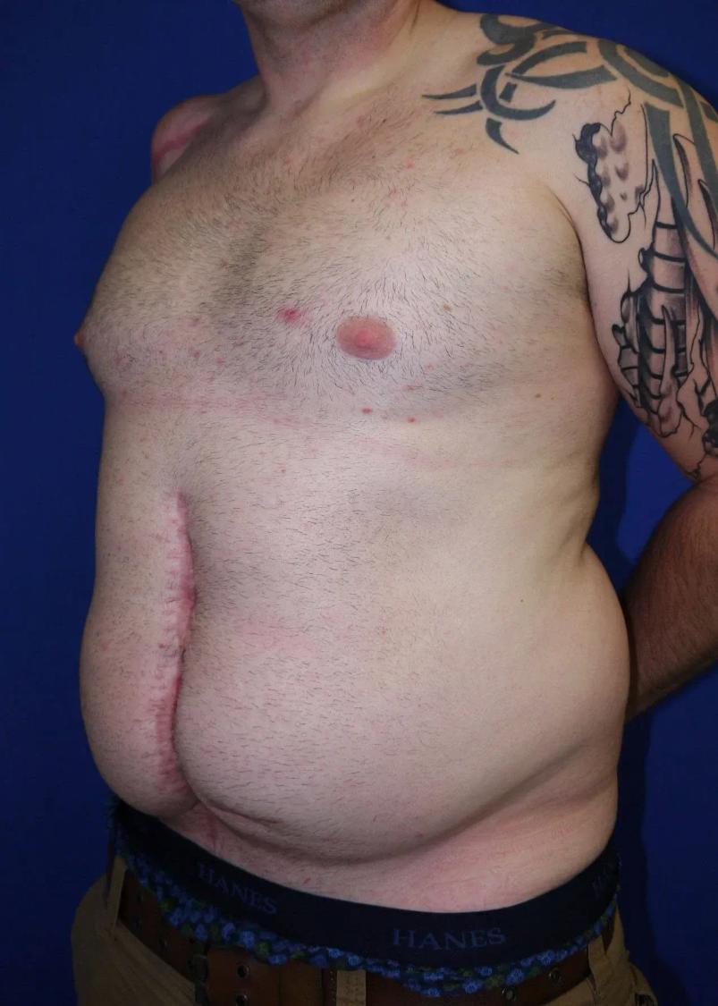 Tummy Tuck before
