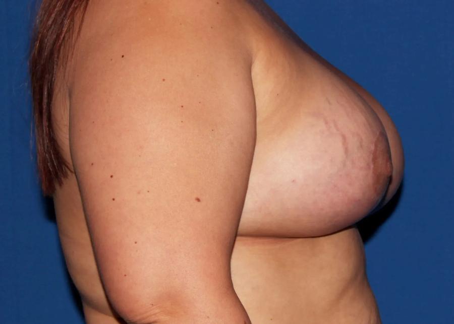 Breast Augmentation with Implants, view 2, after
