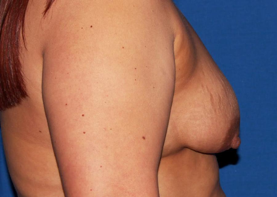 Breast Augmentation with Implants, view 2, before