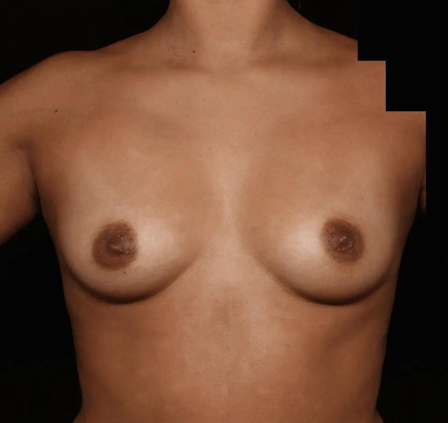 Breast Augmentation with Implants before