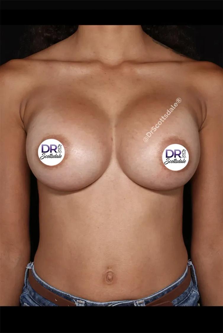 Breast Augmentation with Implants after