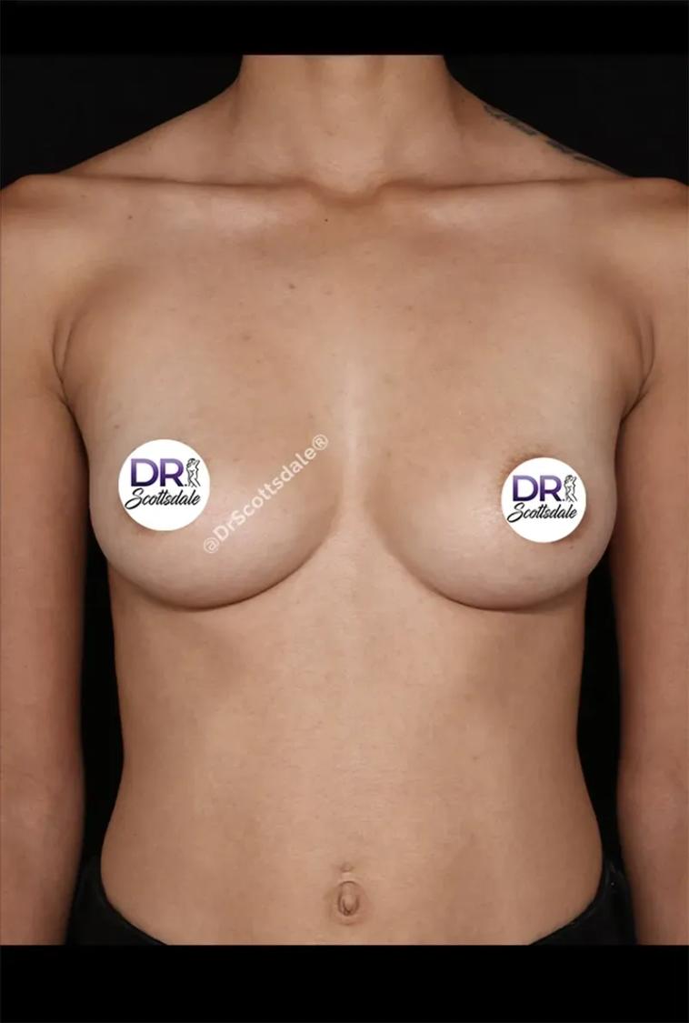 Breast Augmentation with Implants before