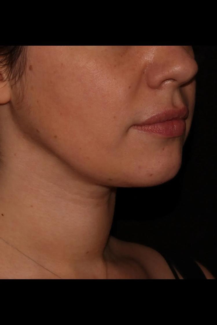 Buccal Fat Pad Removal, view 2, after