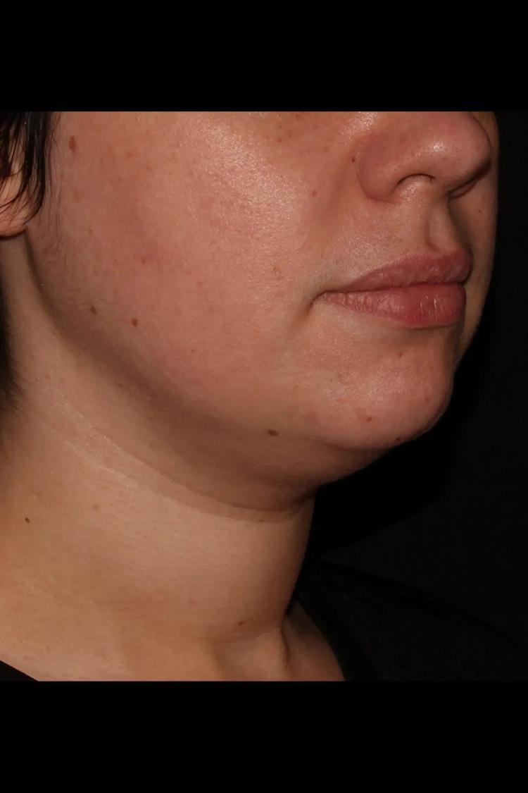 Buccal Fat Pad Removal, view 2, before
