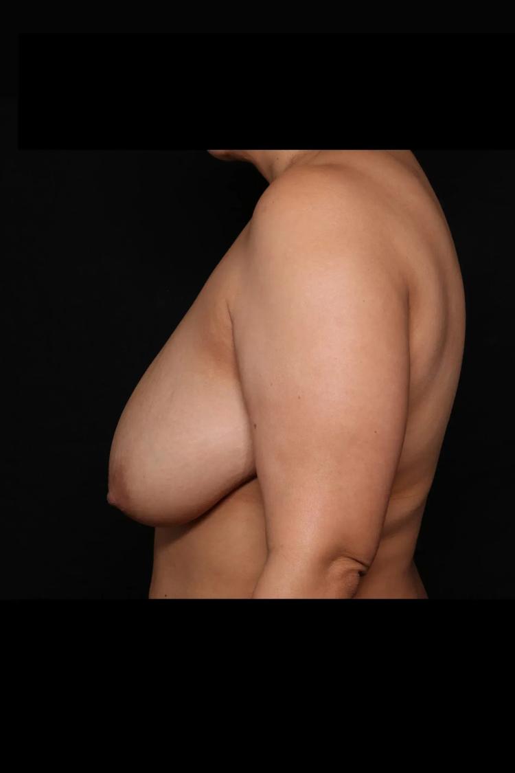 Breast Reduction before