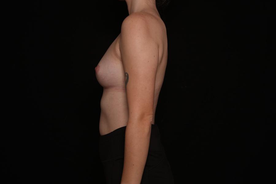 Breast Augmentation with Implants, view 5, before