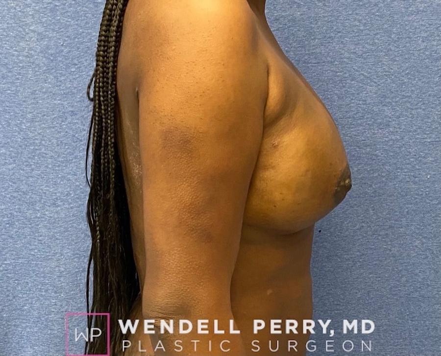 Fat Transfer To the Breast, view 3, after