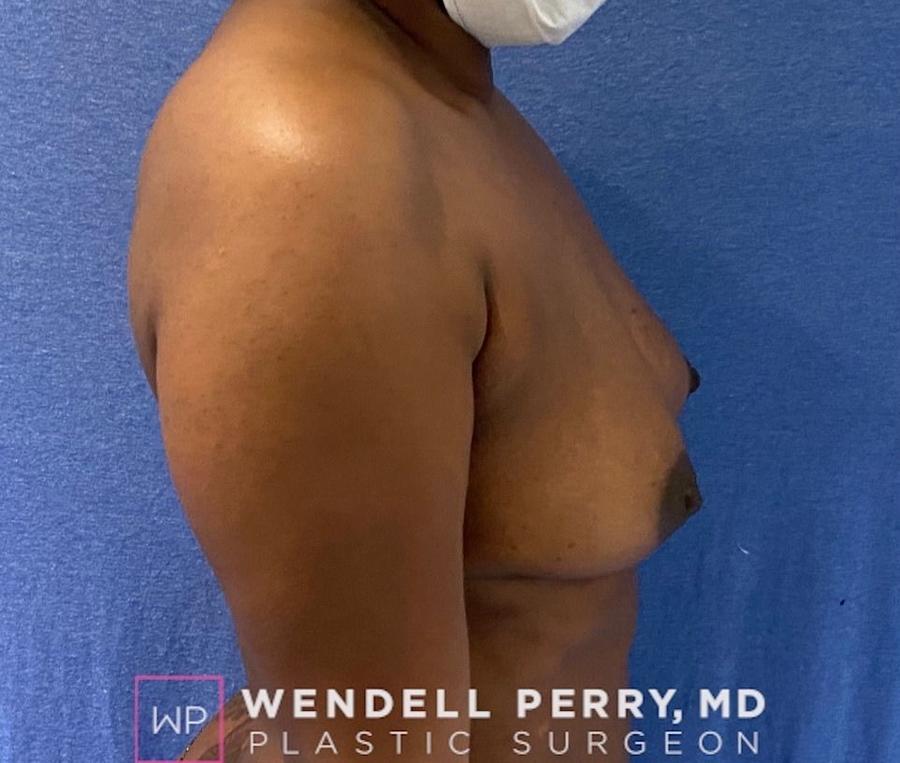 Fat Transfer To the Breast, view 3, before